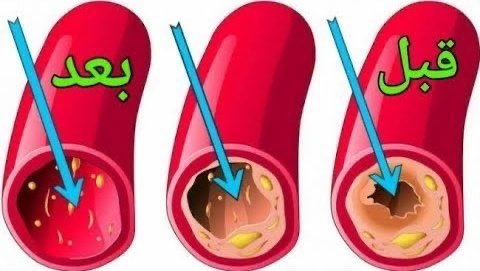 أفضل طريقة لتنظيف الشرايين